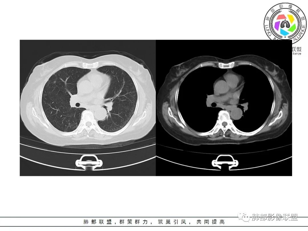 影像PPT - 【病例】披着羊皮的狼—肺炎型肺癌-7 影像PPT - 【病例】披着羊皮的狼—肺炎型肺癌-7