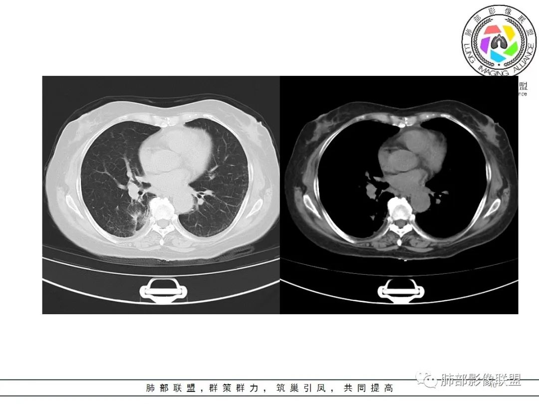 影像PPT - 【病例】披着羊皮的狼—肺炎型肺癌-10 影像PPT - 【病例】披着羊皮的狼—肺炎型肺癌-10