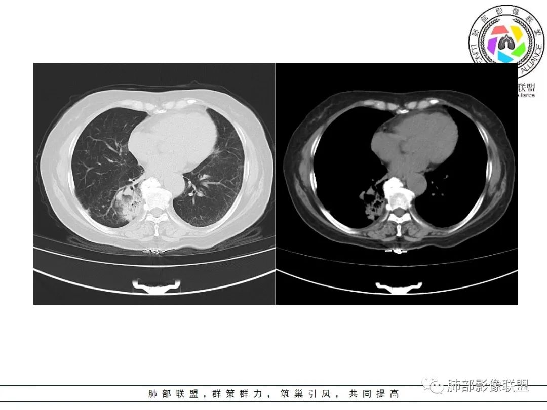 影像PPT - 【病例】披着羊皮的狼—肺炎型肺癌-13 影像PPT - 【病例】披着羊皮的狼—肺炎型肺癌-13