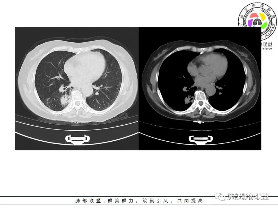 影像PPT - 【病例】披着羊皮的狼—肺炎型肺癌-12 影像PPT - 【病例】披着羊皮的狼—肺炎型肺癌-12