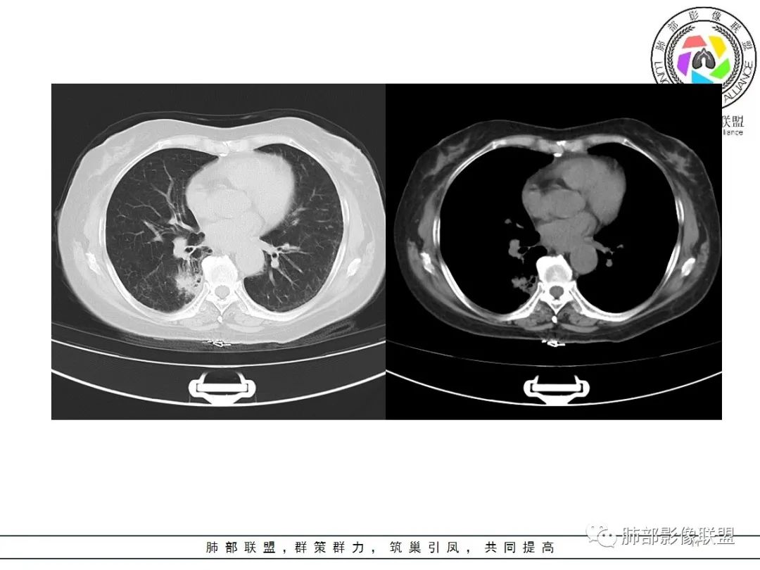 影像PPT - 【病例】披着羊皮的狼—肺炎型肺癌-11 影像PPT - 【病例】披着羊皮的狼—肺炎型肺癌-11