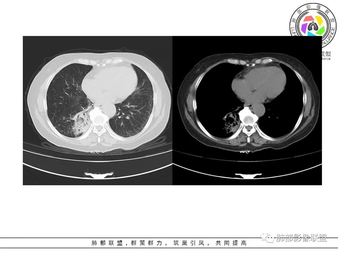 影像PPT - 【病例】披着羊皮的狼—肺炎型肺癌-15 影像PPT - 【病例】披着羊皮的狼—肺炎型肺癌-15