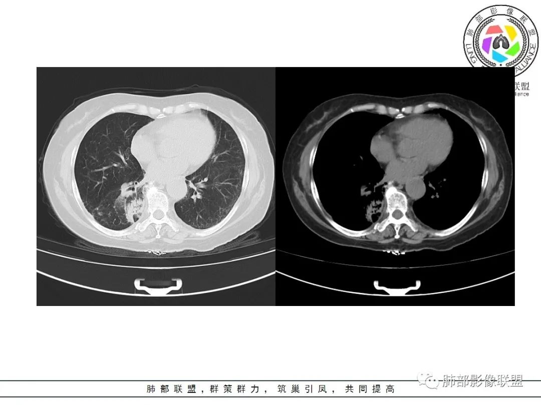 影像PPT - 【病例】披着羊皮的狼—肺炎型肺癌-14 影像PPT - 【病例】披着羊皮的狼—肺炎型肺癌-14