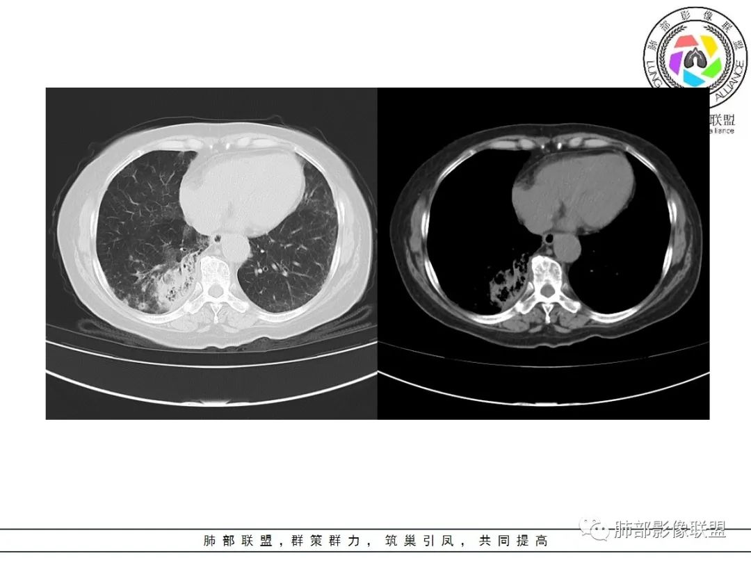 影像PPT - 【病例】披着羊皮的狼—肺炎型肺癌-17 影像PPT - 【病例】披着羊皮的狼—肺炎型肺癌-17