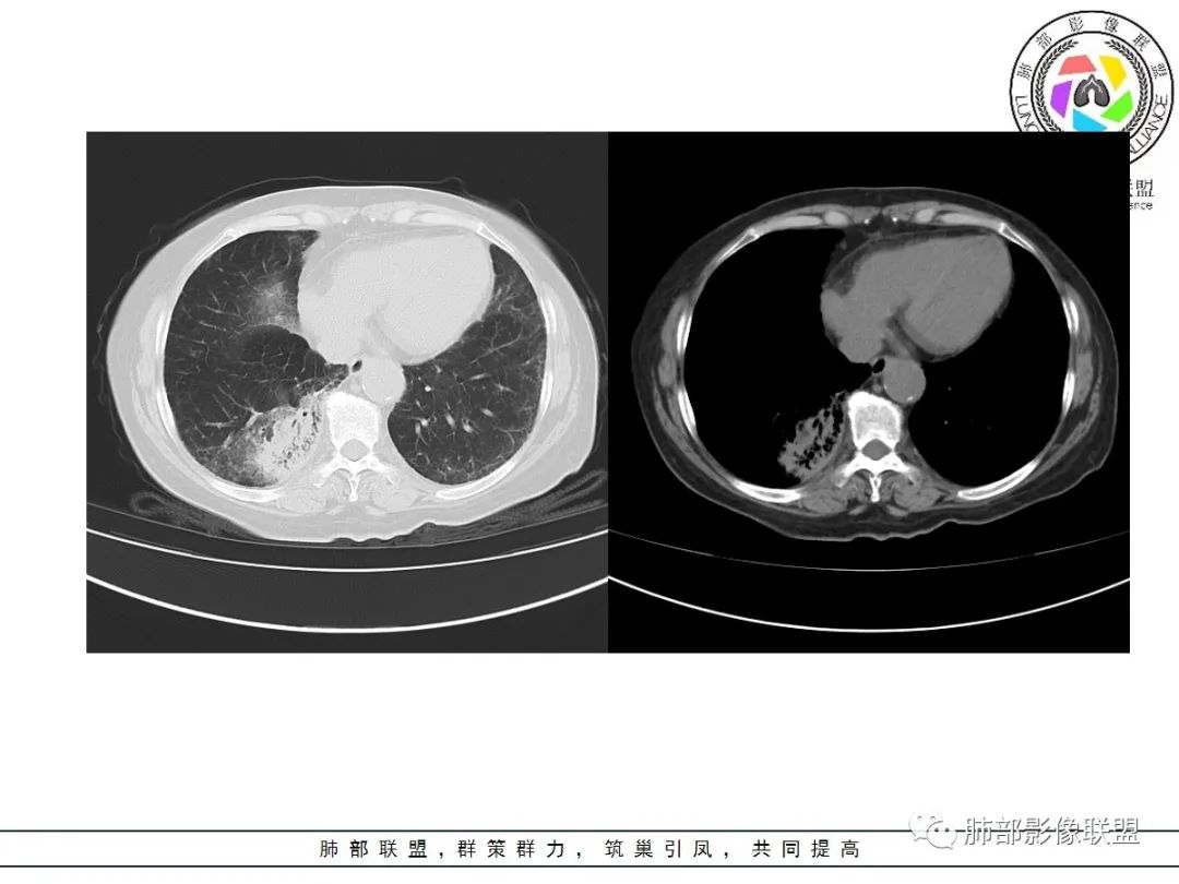 影像PPT - 【病例】披着羊皮的狼—肺炎型肺癌-18 影像PPT - 【病例】披着羊皮的狼—肺炎型肺癌-18
