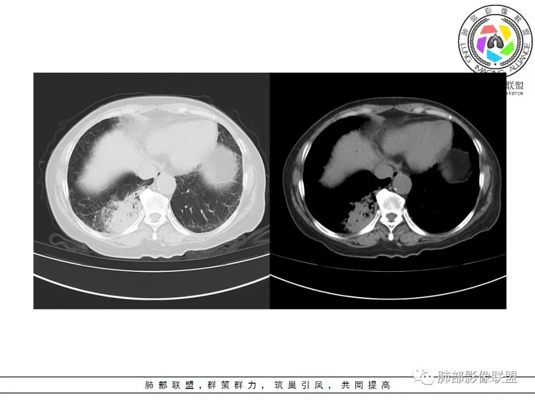 影像PPT - 【病例】披着羊皮的狼—肺炎型肺癌-19 影像PPT - 【病例】披着羊皮的狼—肺炎型肺癌-19