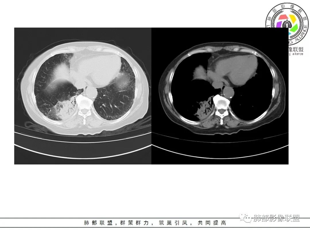 影像PPT - 【病例】披着羊皮的狼—肺炎型肺癌-20 影像PPT - 【病例】披着羊皮的狼—肺炎型肺癌-20