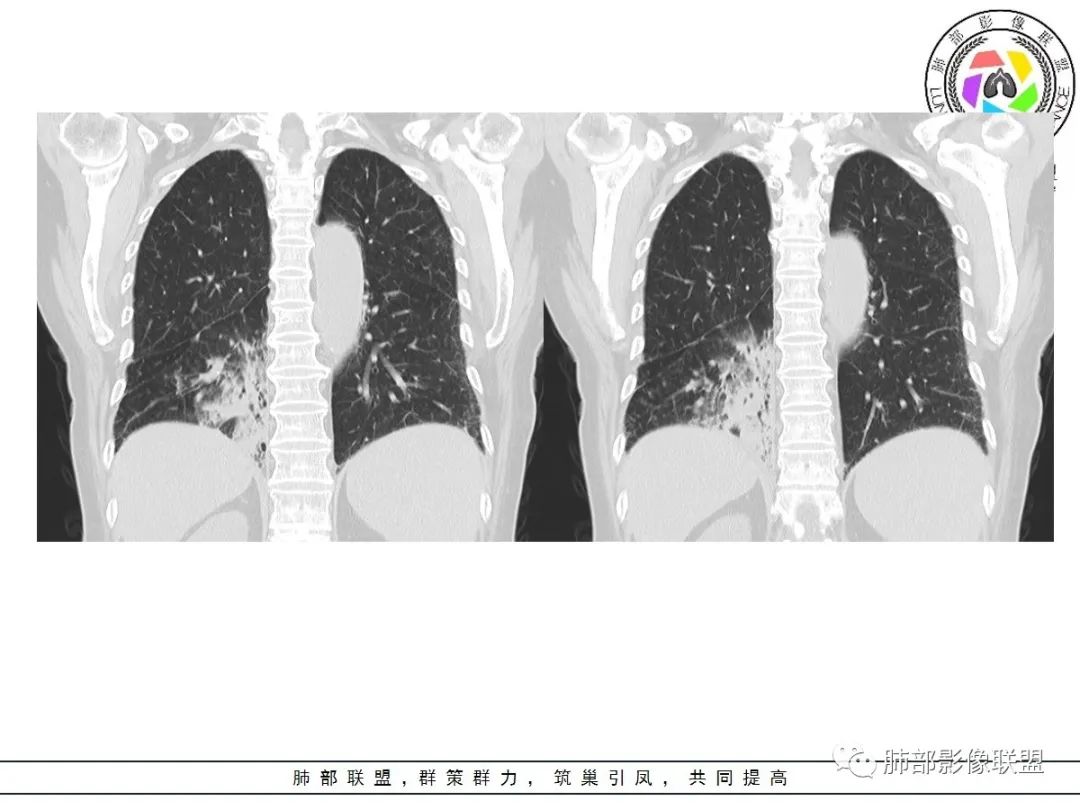 影像PPT - 【病例】披着羊皮的狼—肺炎型肺癌-24 影像PPT - 【病例】披着羊皮的狼—肺炎型肺癌-24