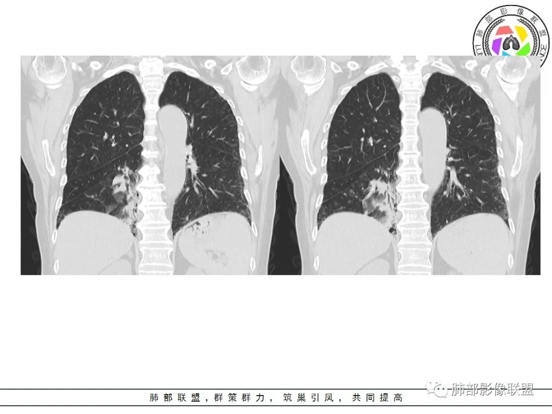影像PPT - 【病例】披着羊皮的狼—肺炎型肺癌-25 影像PPT - 【病例】披着羊皮的狼—肺炎型肺癌-25