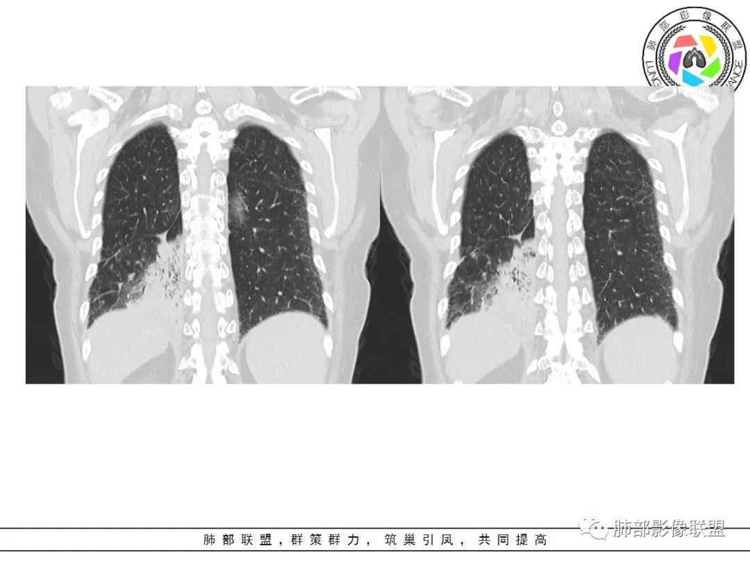 影像PPT - 【病例】披着羊皮的狼—肺炎型肺癌-27 影像PPT - 【病例】披着羊皮的狼—肺炎型肺癌-27