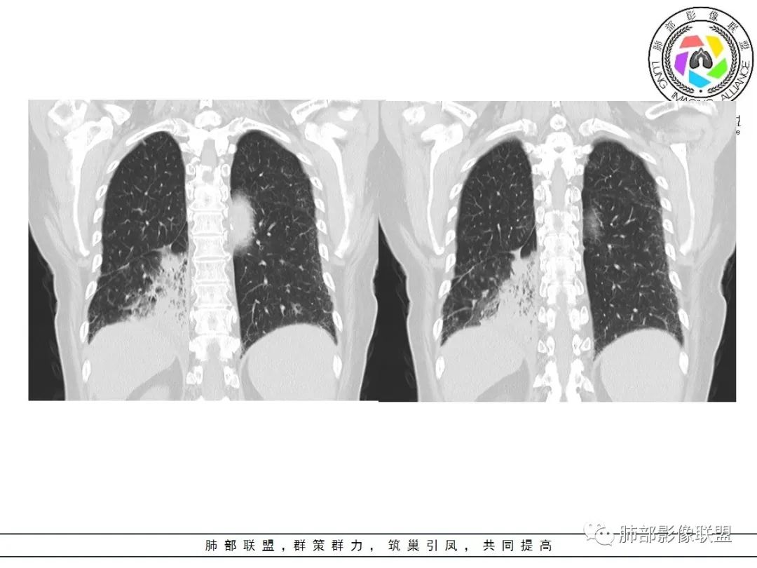 影像PPT - 【病例】披着羊皮的狼—肺炎型肺癌-26 影像PPT - 【病例】披着羊皮的狼—肺炎型肺癌-26