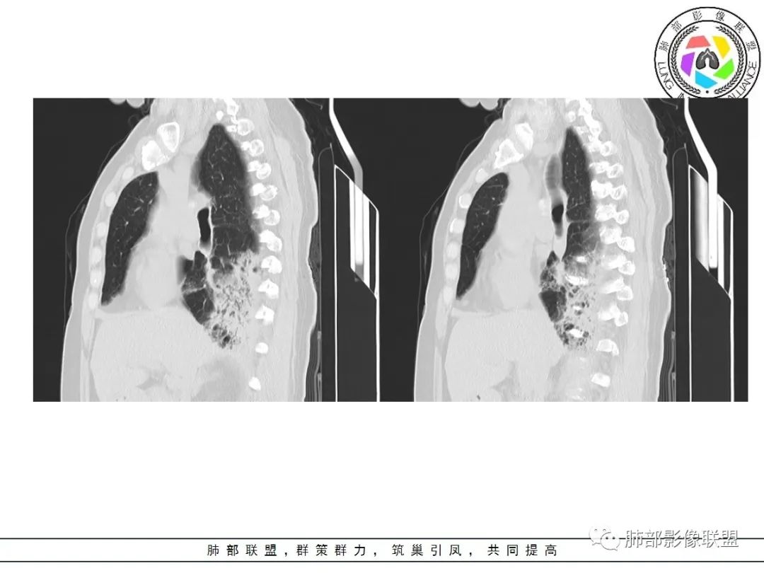 影像PPT - 【病例】披着羊皮的狼—肺炎型肺癌-28 影像PPT - 【病例】披着羊皮的狼—肺炎型肺癌-28