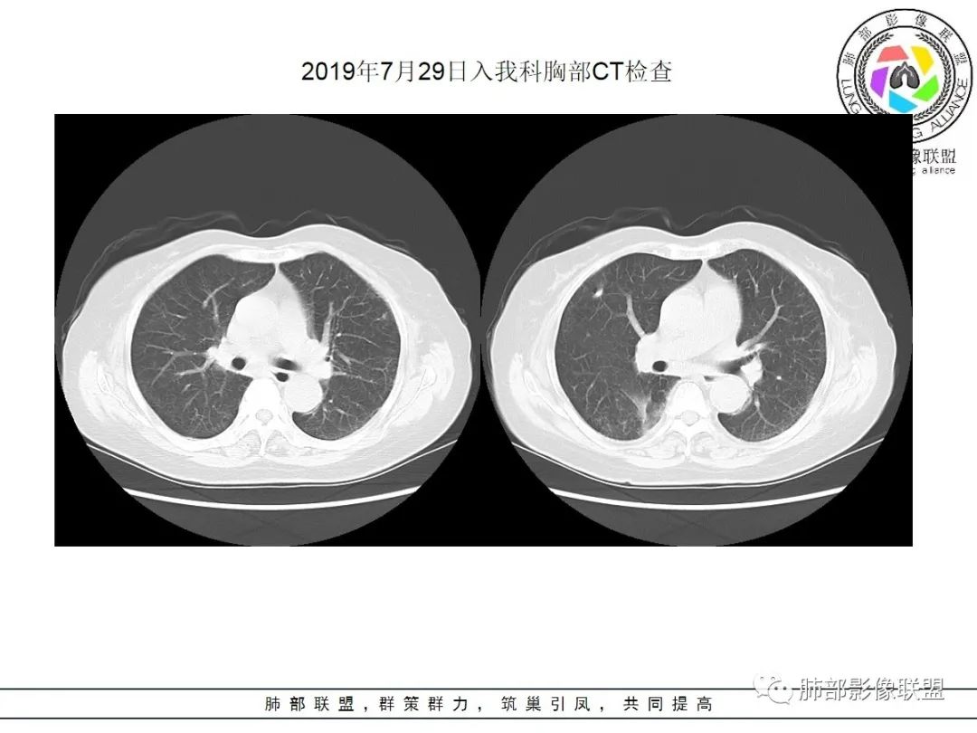 影像PPT - 【病例】披着羊皮的狼—肺炎型肺癌-30 影像PPT - 【病例】披着羊皮的狼—肺炎型肺癌-30