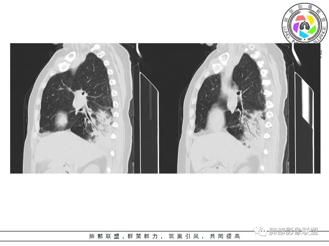 影像PPT - 【病例】披着羊皮的狼—肺炎型肺癌-29 影像PPT - 【病例】披着羊皮的狼—肺炎型肺癌-29