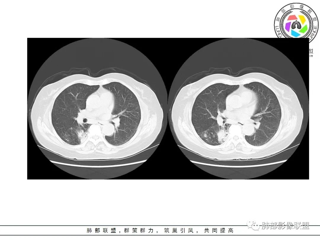 影像PPT - 【病例】披着羊皮的狼—肺炎型肺癌-31 影像PPT - 【病例】披着羊皮的狼—肺炎型肺癌-31