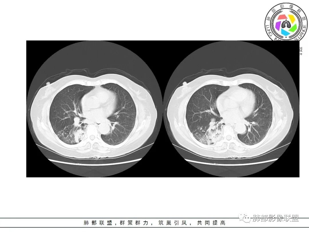 影像PPT - 【病例】披着羊皮的狼—肺炎型肺癌-32 影像PPT - 【病例】披着羊皮的狼—肺炎型肺癌-32