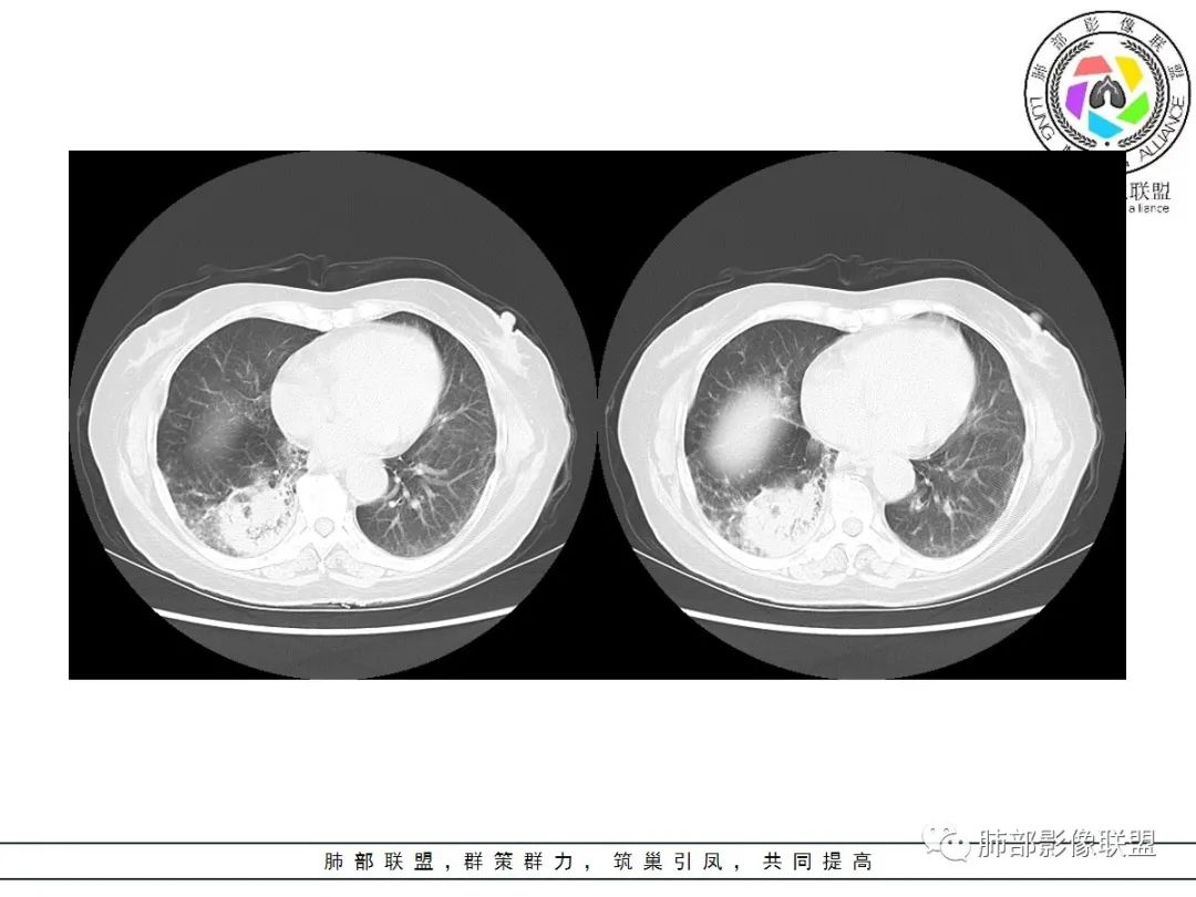 影像PPT - 【病例】披着羊皮的狼—肺炎型肺癌-34 影像PPT - 【病例】披着羊皮的狼—肺炎型肺癌-34