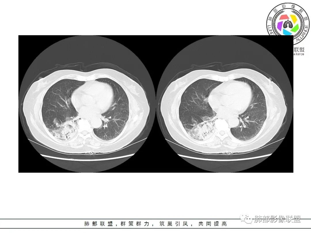 影像PPT - 【病例】披着羊皮的狼—肺炎型肺癌-33 影像PPT - 【病例】披着羊皮的狼—肺炎型肺癌-33