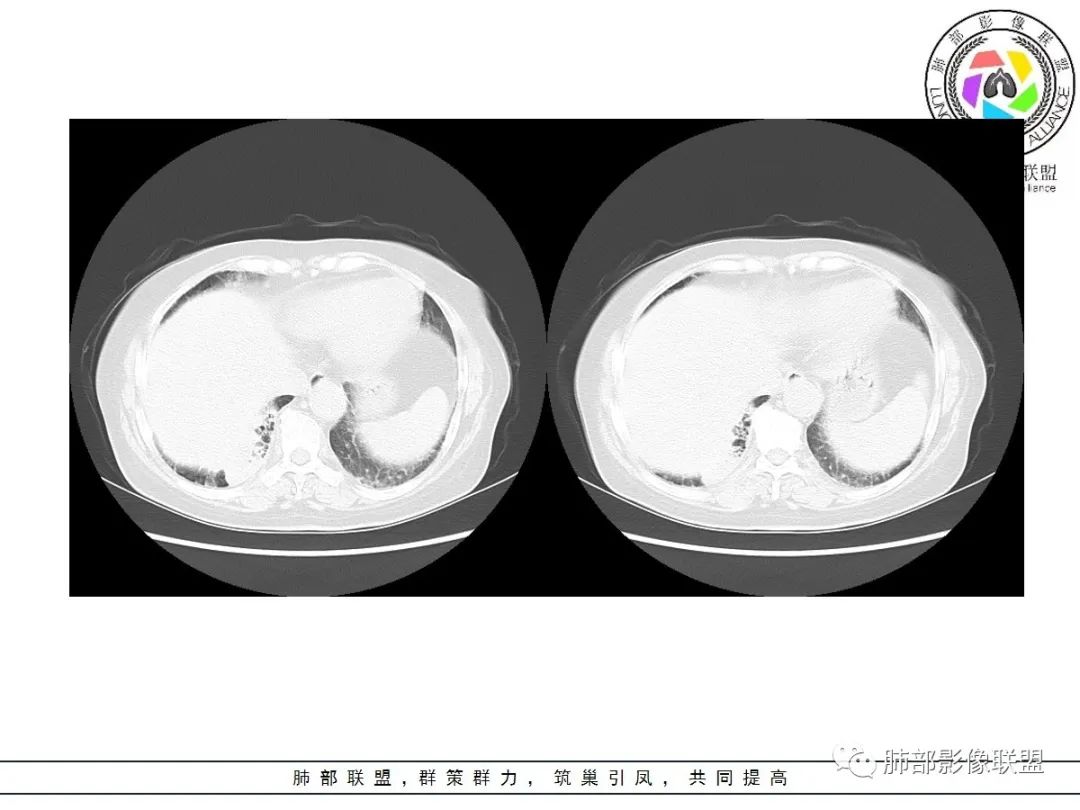 影像PPT - 【病例】披着羊皮的狼—肺炎型肺癌-37 影像PPT - 【病例】披着羊皮的狼—肺炎型肺癌-37