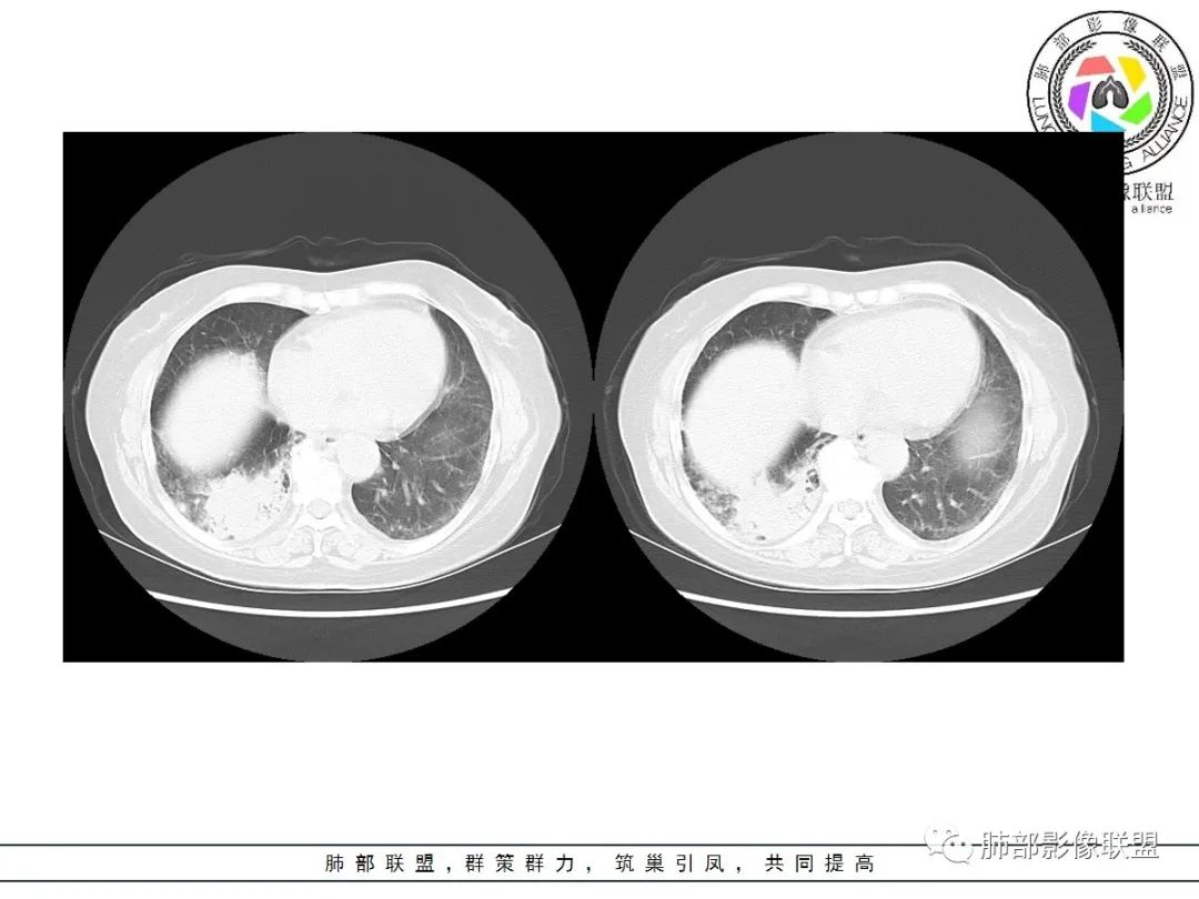 影像PPT - 【病例】披着羊皮的狼—肺炎型肺癌-35 影像PPT - 【病例】披着羊皮的狼—肺炎型肺癌-35
