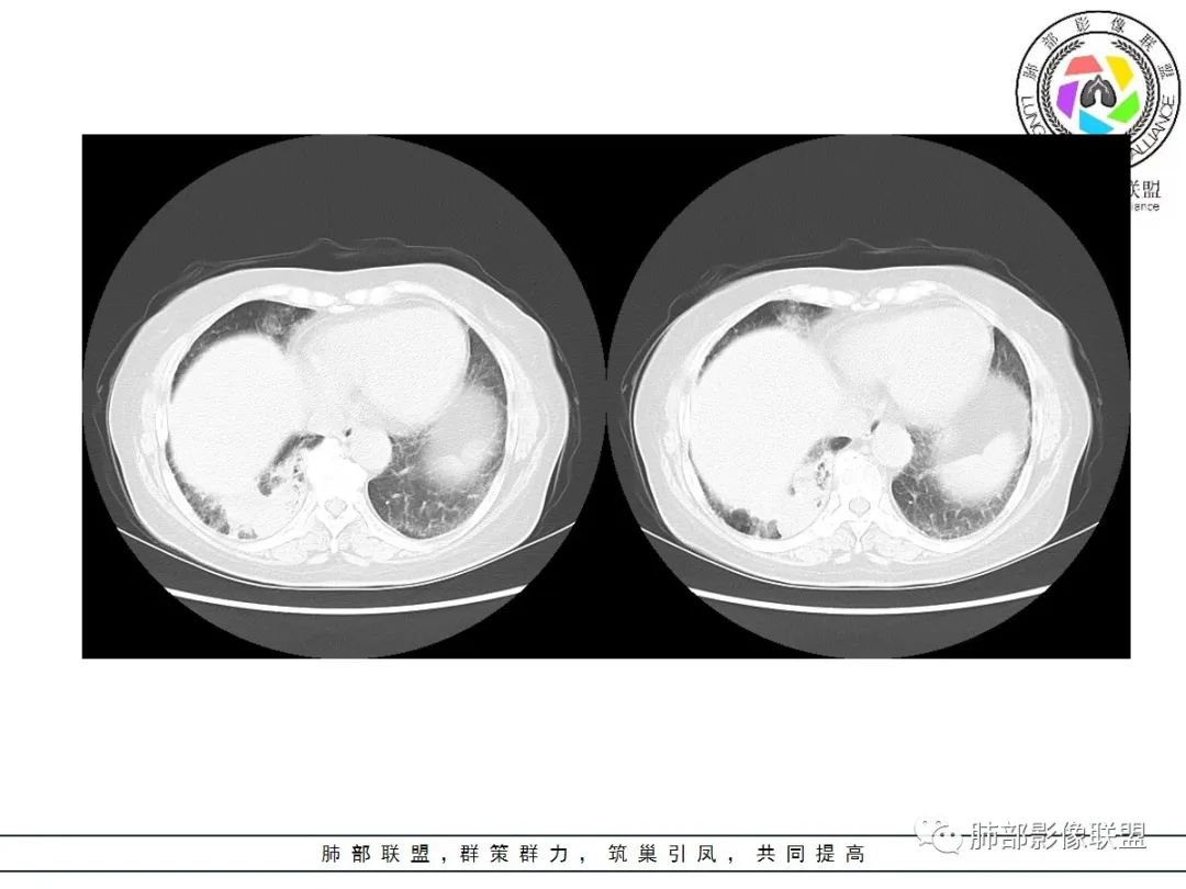 影像PPT - 【病例】披着羊皮的狼—肺炎型肺癌-36 影像PPT - 【病例】披着羊皮的狼—肺炎型肺癌-36