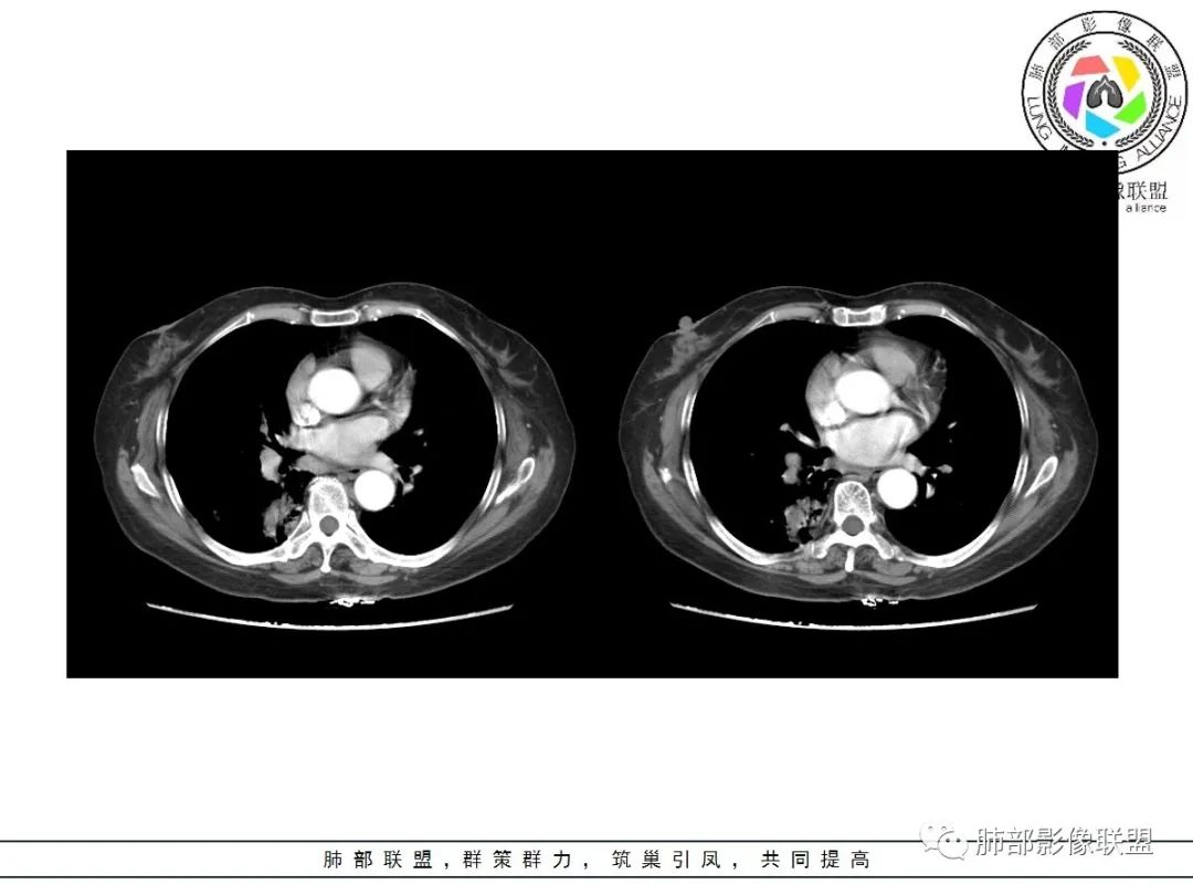 影像PPT - 【病例】披着羊皮的狼—肺炎型肺癌-40 影像PPT - 【病例】披着羊皮的狼—肺炎型肺癌-40