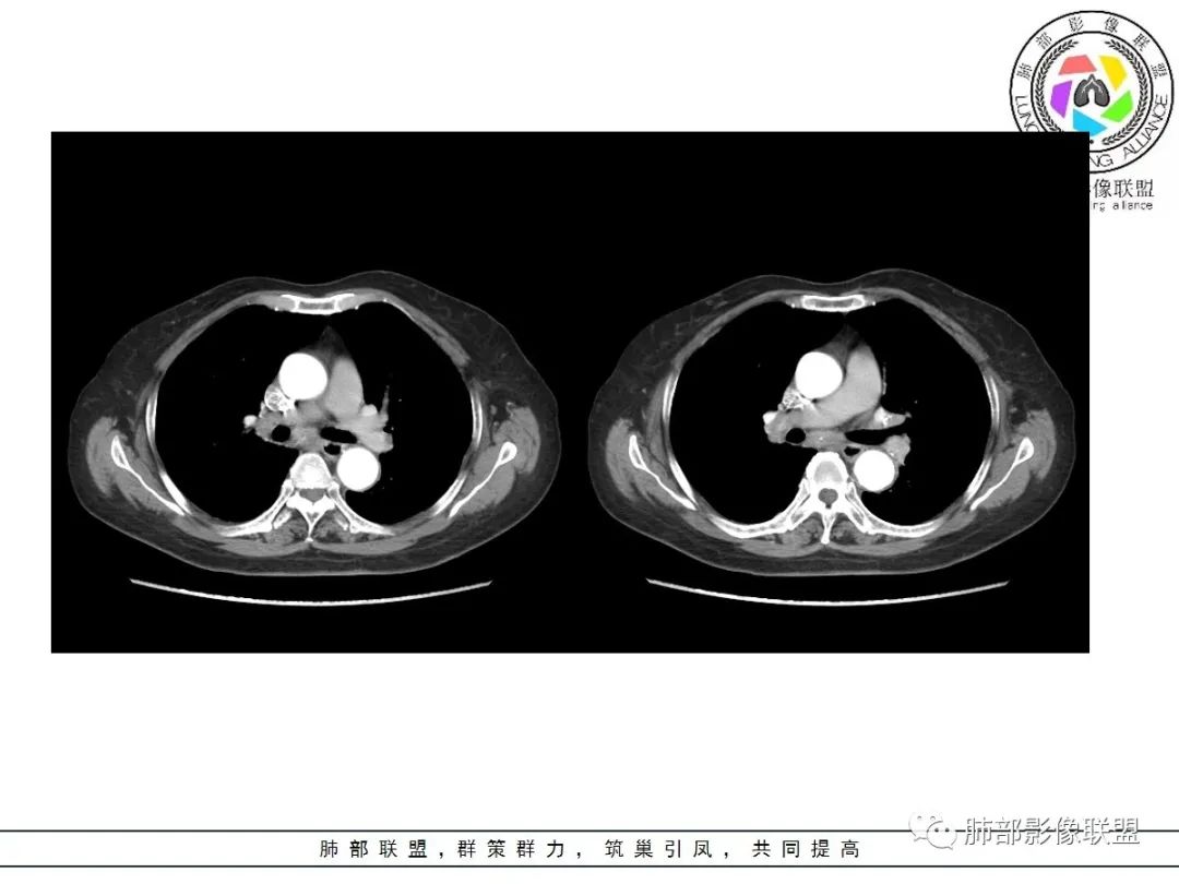 影像PPT - 【病例】披着羊皮的狼—肺炎型肺癌-39 影像PPT - 【病例】披着羊皮的狼—肺炎型肺癌-39