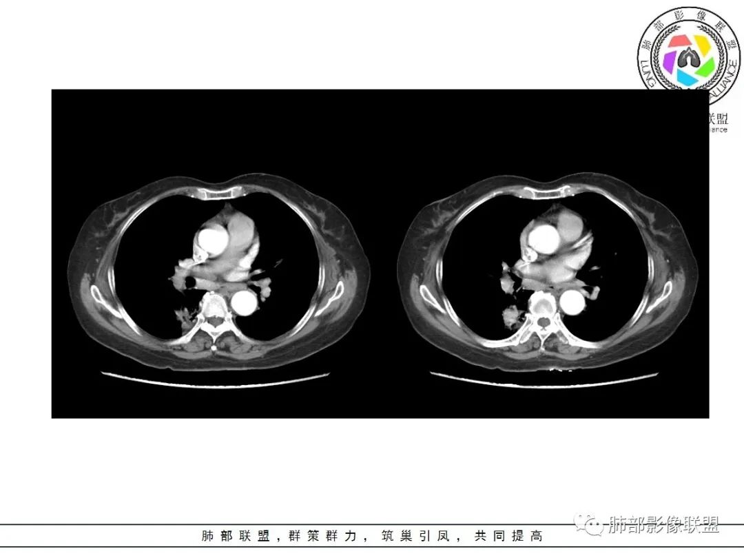 影像PPT - 【病例】披着羊皮的狼—肺炎型肺癌-38 影像PPT - 【病例】披着羊皮的狼—肺炎型肺癌-38