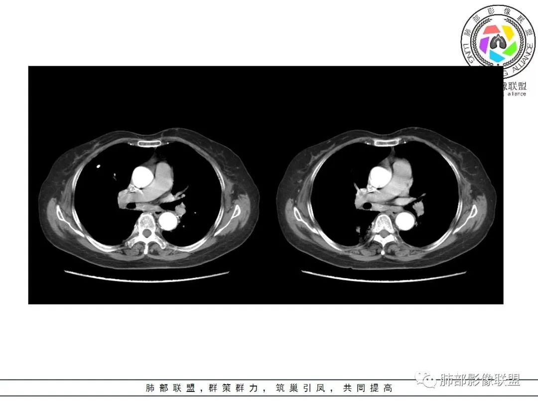影像PPT - 【病例】披着羊皮的狼—肺炎型肺癌-41 影像PPT - 【病例】披着羊皮的狼—肺炎型肺癌-41