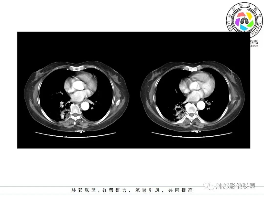 影像PPT - 【病例】披着羊皮的狼—肺炎型肺癌-42 影像PPT - 【病例】披着羊皮的狼—肺炎型肺癌-42