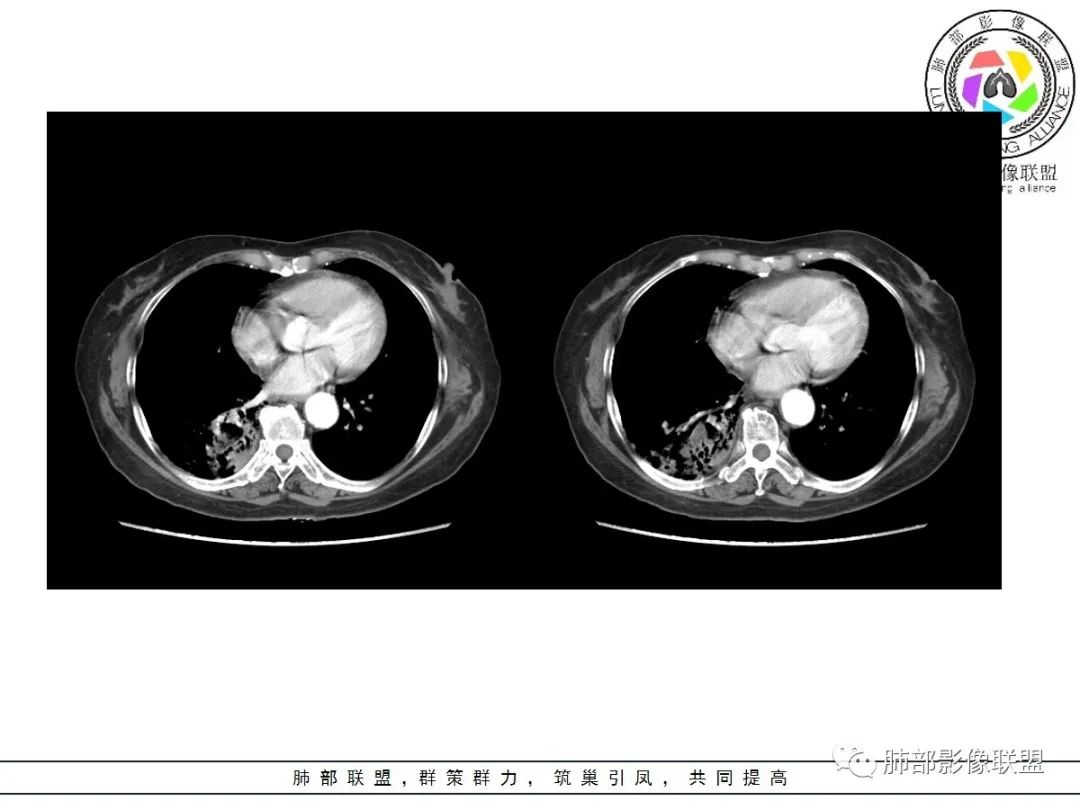 影像PPT - 【病例】披着羊皮的狼—肺炎型肺癌-43 影像PPT - 【病例】披着羊皮的狼—肺炎型肺癌-43