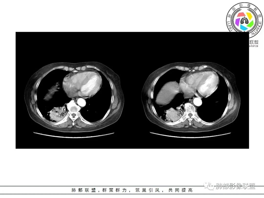 影像PPT - 【病例】披着羊皮的狼—肺炎型肺癌-44 影像PPT - 【病例】披着羊皮的狼—肺炎型肺癌-44