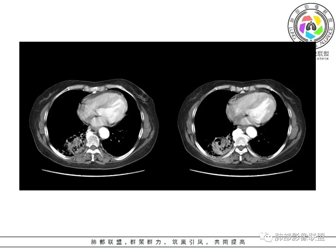影像PPT - 【病例】披着羊皮的狼—肺炎型肺癌-45 影像PPT - 【病例】披着羊皮的狼—肺炎型肺癌-45