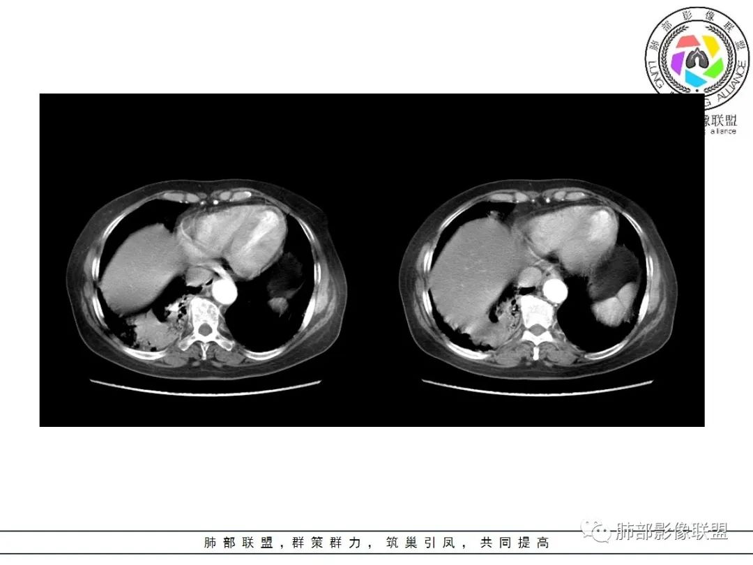 影像PPT - 【病例】披着羊皮的狼—肺炎型肺癌-46 影像PPT - 【病例】披着羊皮的狼—肺炎型肺癌-46