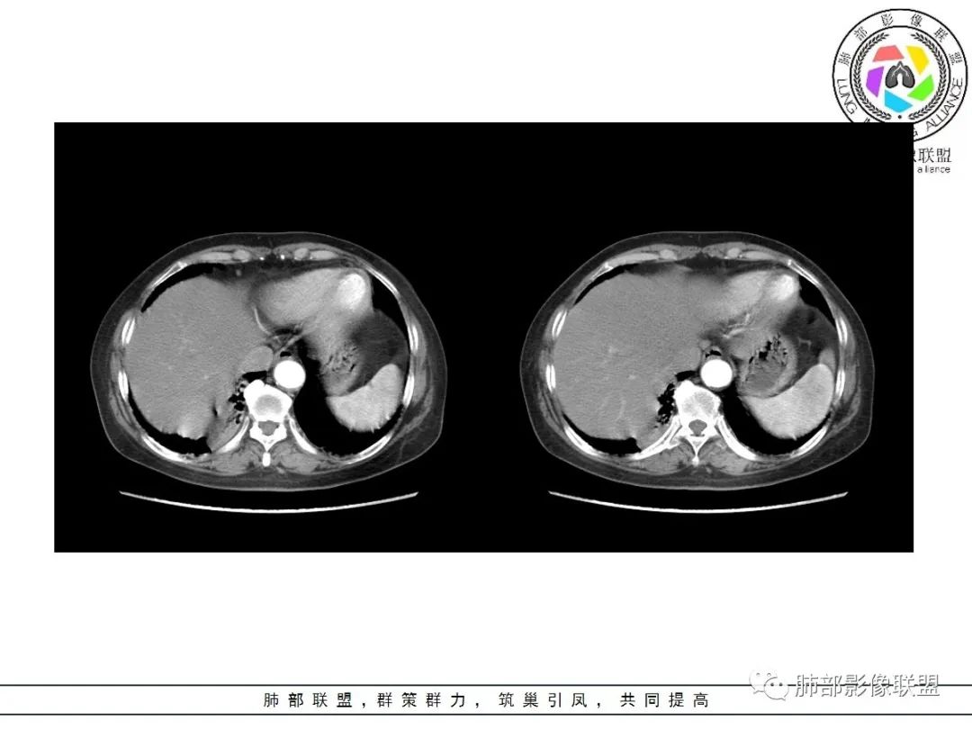 影像PPT - 【病例】披着羊皮的狼—肺炎型肺癌-47 影像PPT - 【病例】披着羊皮的狼—肺炎型肺癌-47