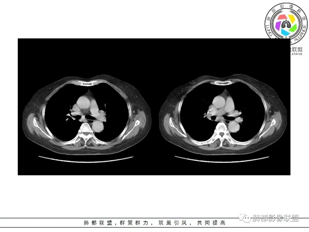 影像PPT - 【病例】披着羊皮的狼—肺炎型肺癌-48 影像PPT - 【病例】披着羊皮的狼—肺炎型肺癌-48