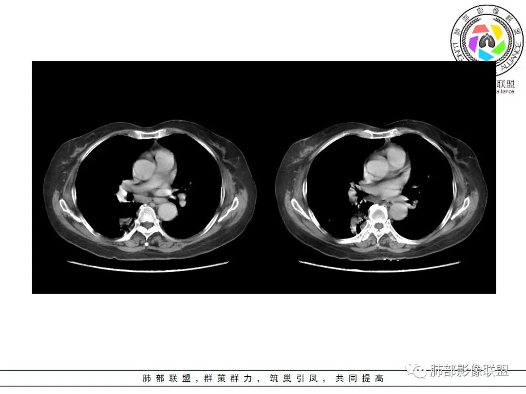 影像PPT - 【病例】披着羊皮的狼—肺炎型肺癌-50 影像PPT - 【病例】披着羊皮的狼—肺炎型肺癌-50