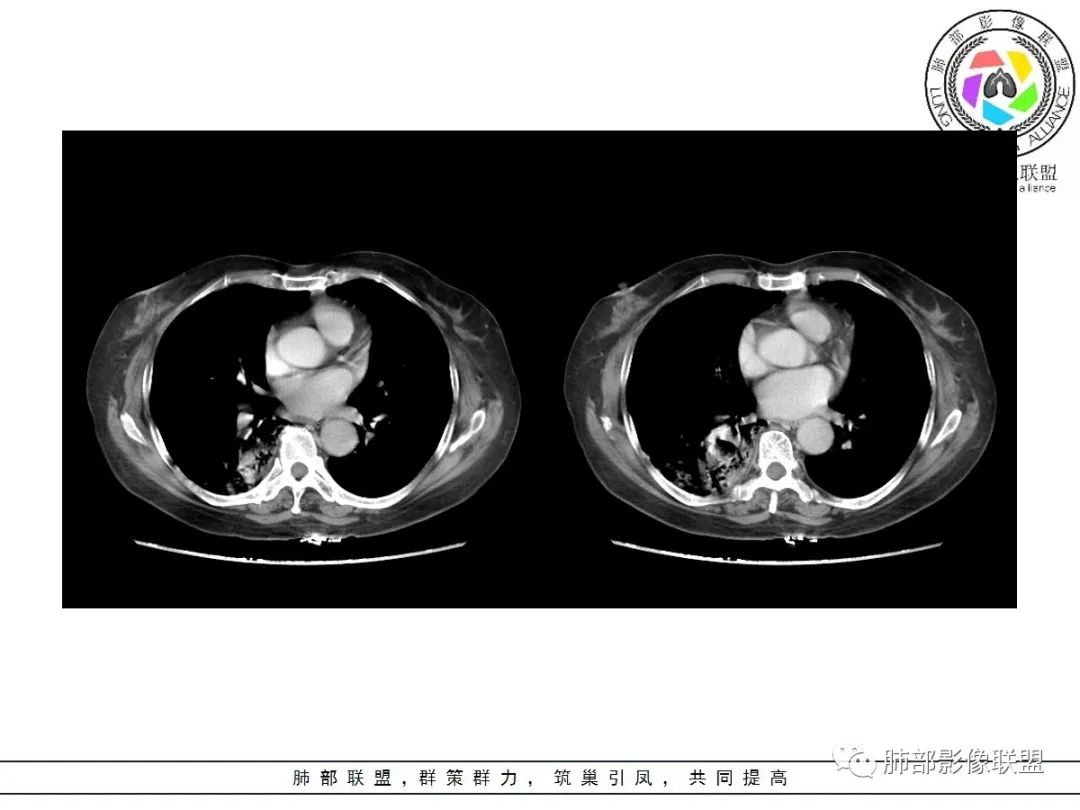 影像PPT - 【病例】披着羊皮的狼—肺炎型肺癌-51 影像PPT - 【病例】披着羊皮的狼—肺炎型肺癌-51