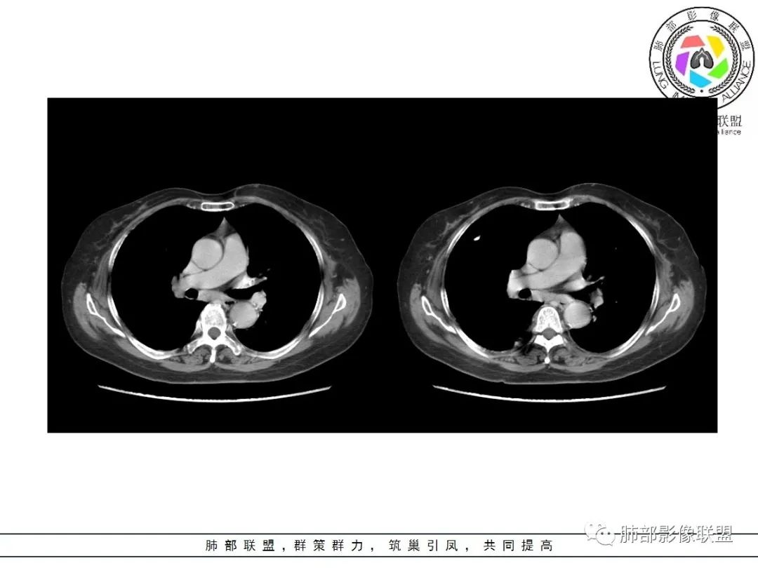影像PPT - 【病例】披着羊皮的狼—肺炎型肺癌-49 影像PPT - 【病例】披着羊皮的狼—肺炎型肺癌-49