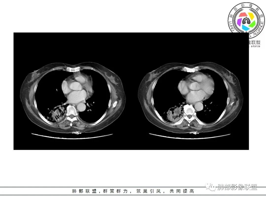 影像PPT - 【病例】披着羊皮的狼—肺炎型肺癌-52 影像PPT - 【病例】披着羊皮的狼—肺炎型肺癌-52