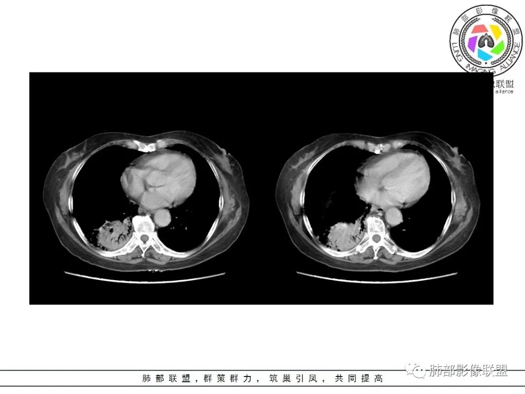 影像PPT - 【病例】披着羊皮的狼—肺炎型肺癌-53 影像PPT - 【病例】披着羊皮的狼—肺炎型肺癌-53