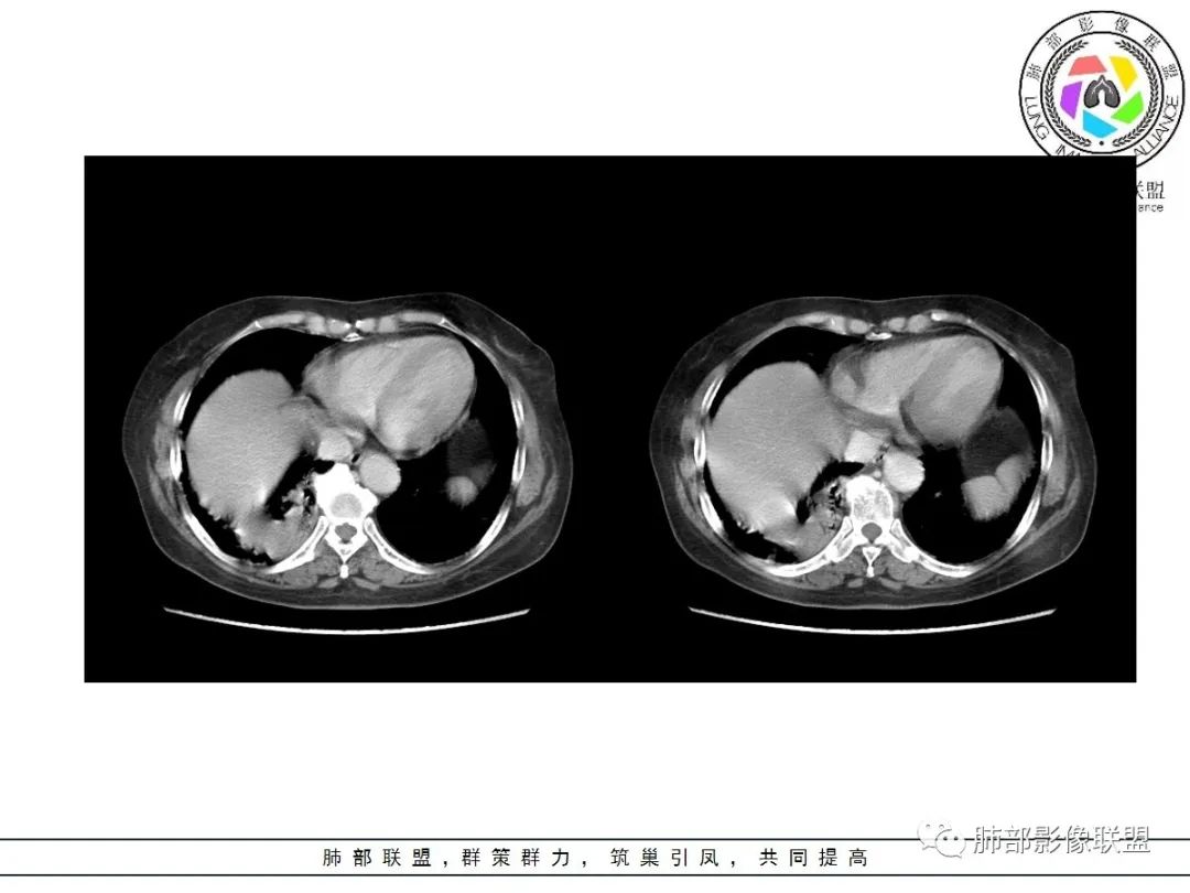 影像PPT - 【病例】披着羊皮的狼—肺炎型肺癌-55 影像PPT - 【病例】披着羊皮的狼—肺炎型肺癌-55