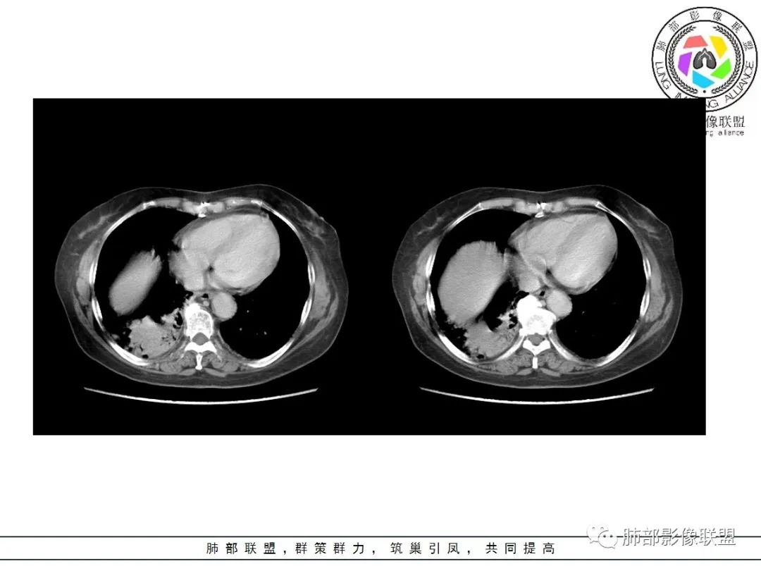 影像PPT - 【病例】披着羊皮的狼—肺炎型肺癌-54 影像PPT - 【病例】披着羊皮的狼—肺炎型肺癌-54