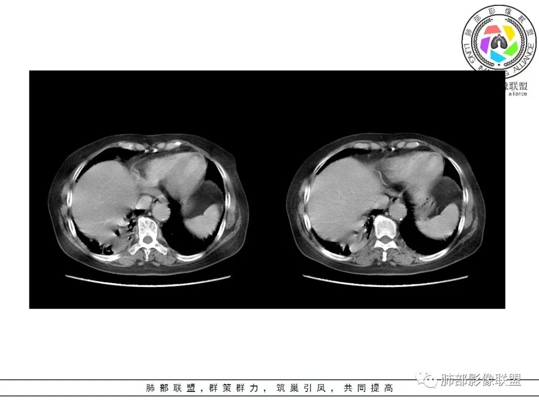 影像PPT - 【病例】披着羊皮的狼—肺炎型肺癌-56 影像PPT - 【病例】披着羊皮的狼—肺炎型肺癌-56