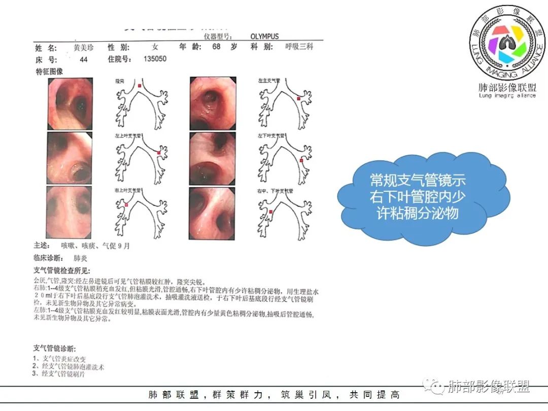 影像PPT - 【病例】披着羊皮的狼—肺炎型肺癌-57 影像PPT - 【病例】披着羊皮的狼—肺炎型肺癌-57