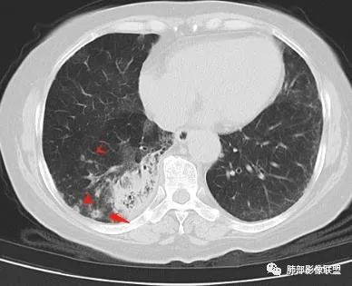 影像PPT - 【病例】披着羊皮的狼—肺炎型肺癌-68 影像PPT - 【病例】披着羊皮的狼—肺炎型肺癌-68