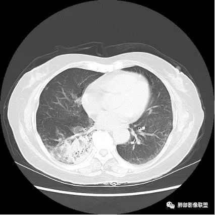 影像PPT - 【病例】披着羊皮的狼—肺炎型肺癌-71 影像PPT - 【病例】披着羊皮的狼—肺炎型肺癌-71