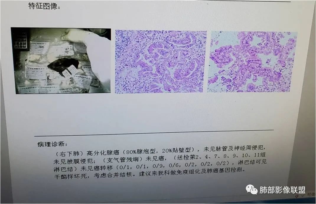 影像PPT - 【病例】披着羊皮的狼—肺炎型肺癌-79 影像PPT - 【病例】披着羊皮的狼—肺炎型肺癌-79