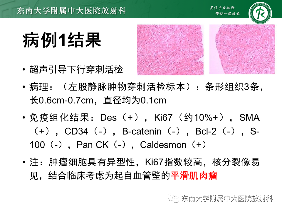 影像PPT - 【PPT】下腔静脉栓塞性病变随访-6 影像PPT - 【PPT】下腔静脉栓塞性病变随访-6