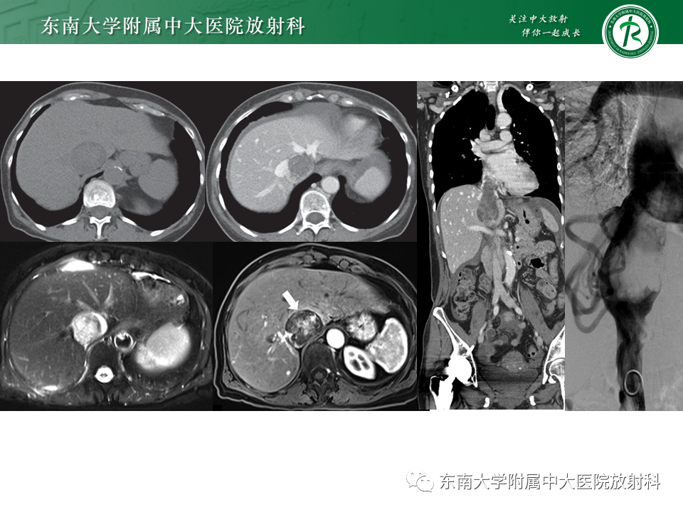 影像PPT - 【PPT】下腔静脉栓塞性病变随访-17 影像PPT - 【PPT】下腔静脉栓塞性病变随访-17